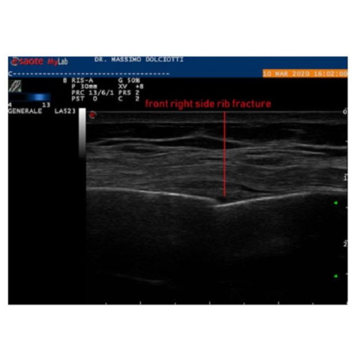 Ecografia e fratture costali